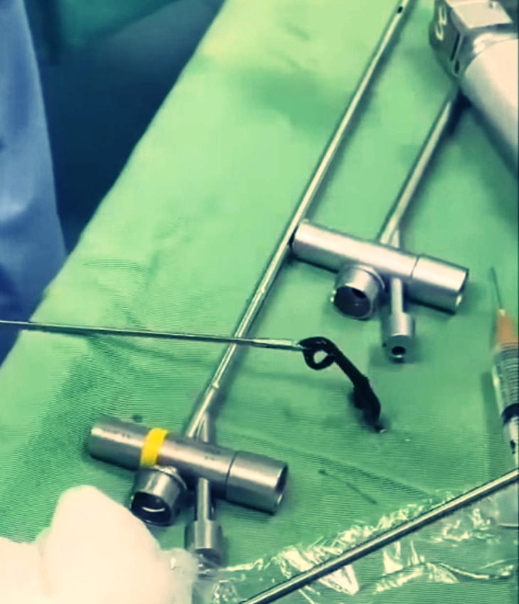 Kinh hãi vắt rừng dài 8cm trốn trong đường thở của bệnh nhân - Ảnh 1.