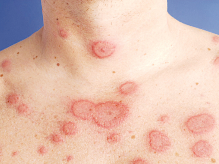 Lupus do đâu, cách nào để trị? - Ảnh 1.