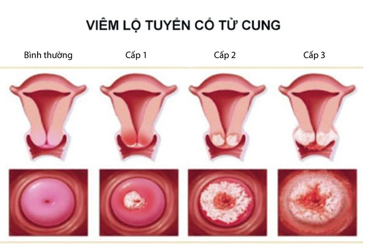 Tắc vòi trứng gây vô sinh ở phụ nữ? - Ảnh 2.