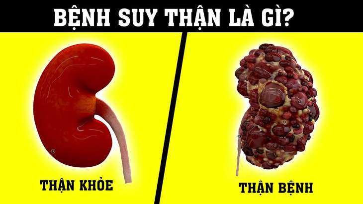Những thói quen sai lầm dẫn đến suy thận - Ảnh 2. Những thói quen sai lầm dẫn đến suy thận - Ảnh 2.