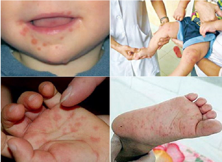 Nam Trung Bộ: Cảnh giác với bệnh tay chân miệng - Ảnh 2.