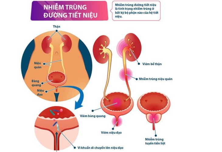 Đàn ông nên cảnh giác với căn bệnh khó chịu tưởng hay gặp ở phụ nữ này - Ảnh 4.