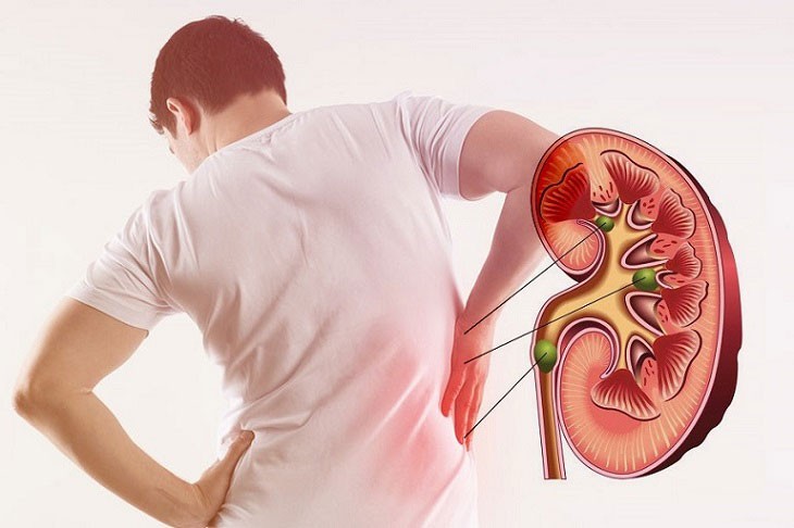 Những thói quen sai lầm dẫn đến suy thận - Ảnh 3. Những thói quen sai lầm dẫn đến suy thận - Ảnh 3.