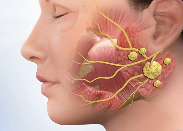 Viêm tuyến nước bọt mang tai là gì? Có nguy hiểm không? - Ảnh 2.
