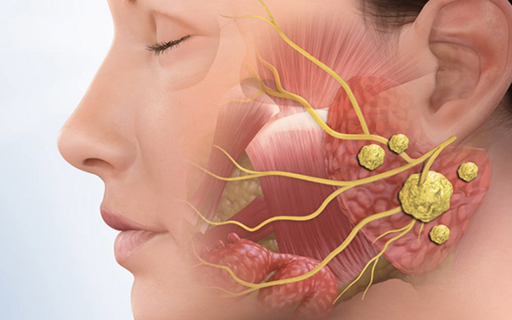 Viêm tuyến nước bọt mang tai có nguy hiểm không?