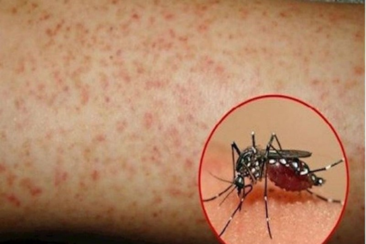 4 bài thuốc điều trị sốt xuất huyết và những lưu ý quan trọng - Ảnh 2. 4 bài thuốc điều trị sốt xuất huyết và những lưu ý quan trọng - Ảnh 2.