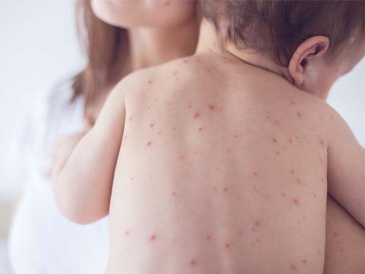 Sốt xuất huyết ở trẻ em: Triệu chứng, biến chứng, điều trị và cách chăm sóc tại nhà - Ảnh 5. Sốt xuất huyết ở trẻ em: Triệu chứng, biến chứng, điều trị và cách chăm sóc tại nhà - Ảnh 5.