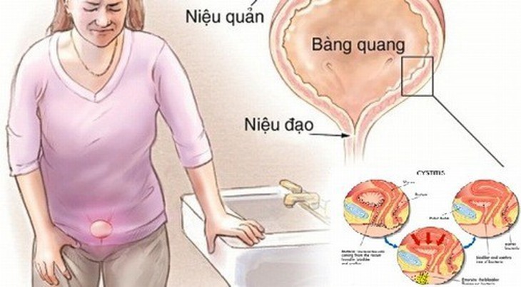 Đi tiểu sau khi quan hệ tình dục có ngăn được nhiễm trùng tiết niệu? - Ảnh 4. Đi tiểu sau khi quan hệ tình dục có ngăn được nhiễm trùng tiết niệu? - Ảnh 4.