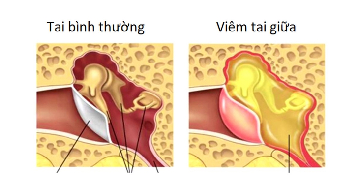 Những sai lầm khi điều trị viêm tai giữa cho trẻ - Ảnh 1. Những sai lầm khi điều trị viêm tai giữa cho trẻ - Ảnh 1.