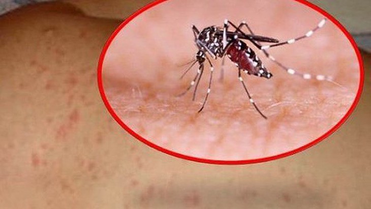 Sốt xuất huyết và những sai lầm cần tránh - Ảnh 3. Sốt xuất huyết và những sai lầm cần tránh - Ảnh 3.