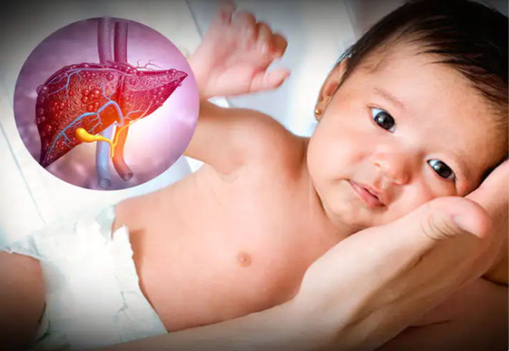 Cảnh giác với viêm gan cấp tính nặng chưa rõ nguyên nhân ở trẻ - Ảnh 3.