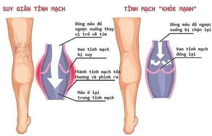 Nguyên nhân không ngờ khiến bạn bị suy giãn tĩnh mạch chân mà không biết - Ảnh 2. Nguyên nhân không ngờ khiến bạn bị suy giãn tĩnh mạch chân mà không biết - Ảnh 2.