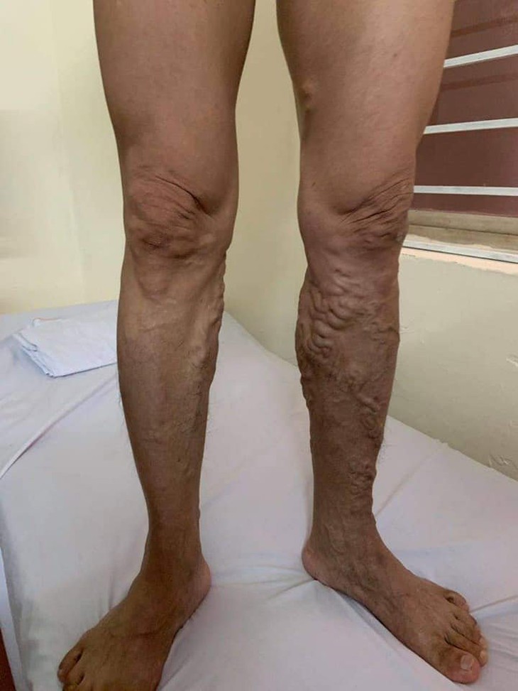 Nguyên nhân không ngờ khiến bạn bị suy giãn tĩnh mạch chân mà không biết - Ảnh 3. Nguyên nhân không ngờ khiến bạn bị suy giãn tĩnh mạch chân mà không biết - Ảnh 3.
