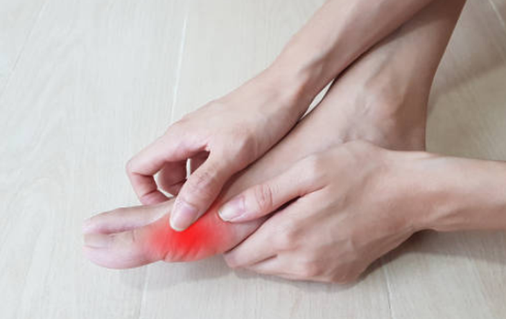 Dấu hiệu nhận biết gout cấp và cách điều trị - Ảnh 1.