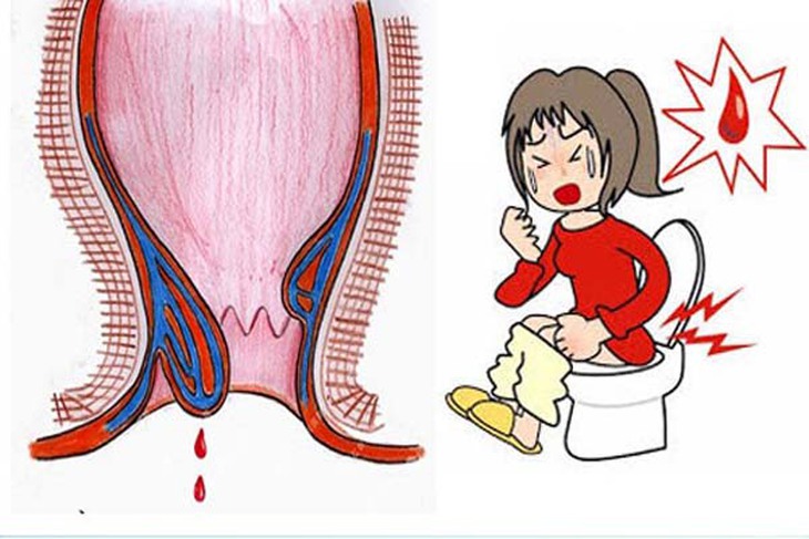 Bí quyết ăn uống giúp phòng và điều trị bệnh trĩ hiệu quả  - Ảnh 2.