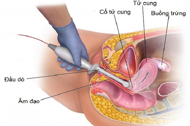 Hội chứng buồng trứng đa nang ảnh hưởng đến quá trình mang thai như thế nào? - Ảnh 2.