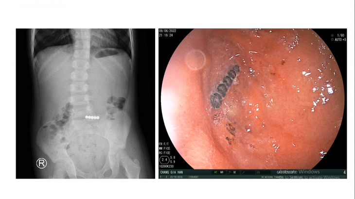Cảnh báo nguy hiểm từ đồ chơi viên bi nam châm - Ảnh 1. Cảnh báo nguy hiểm từ đồ chơi viên bi nam châm - Ảnh 1.