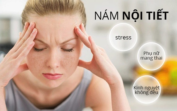 Nám da do nội tiết - cách gì để trị? - Ảnh 1. Nám da do nội tiết - cách gì để trị? - Ảnh 1.