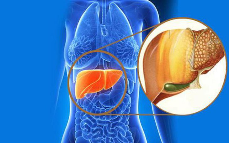 7 biện pháp tự nhiên giúp ngăn ngừa gan nhiễm mỡ