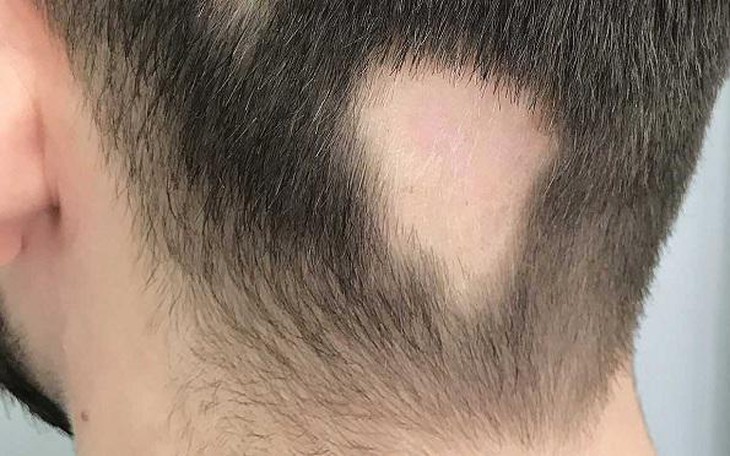 Phương pháp điều trị toàn thân đầu tiên cho chứng rụng tóc từng mảng