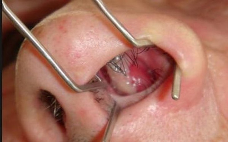 Nhận biết nguyên nhân và điều trị polyp ở mũi tránh tái phát - Ảnh 2.
