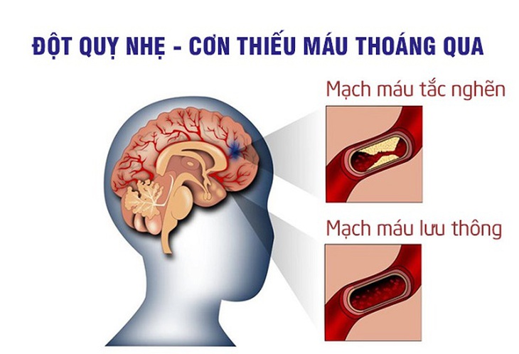 Mặc dù cơn thiếu máu não thoáng qua thường chỉ kéo dài vài phút, sau đó sẽ hết nhưng tình trạng này nên được đánh giá như một cấp cứu khẩn cấp về tai biến mạch máu não để cố gắng ngăn ngừa sự tái phát. Mặc dù cơn thiếu máu não thoáng qua thường chỉ kéo dài vài phút, sau đó sẽ hết nhưng tình trạng này nên được đánh giá như một cấp cứu khẩn cấp về tai biến mạch máu não để cố gắng ngăn ngừa sự tái phát.