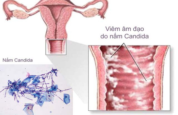 Viêm âm đạo do nấm có ảnh hưởng tới quan hệ tình dục? - Ảnh 3.