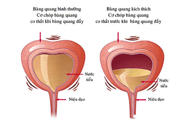 Viêm bàng quang kích thích là gì? Nhận biết nguyên nhân và điều trị - Ảnh 2.