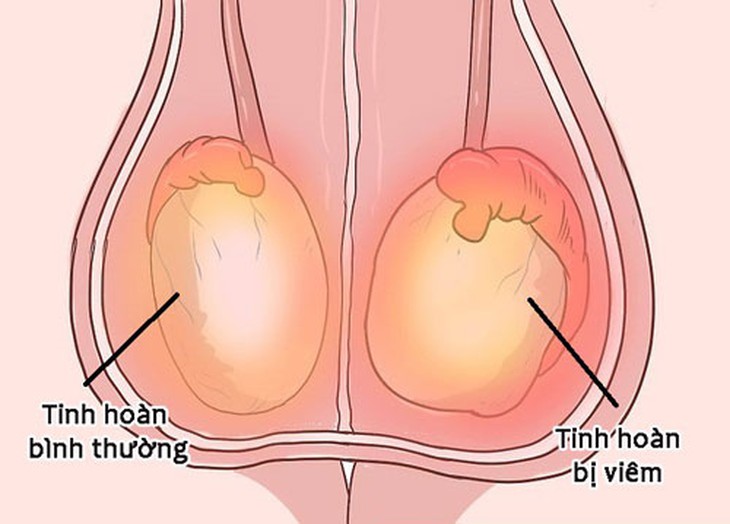 Giải đáp những thắc mắc về hội chứng đau tinh hoàn - Ảnh 2.