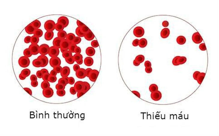 Trẻ lười ăn, kén ăn, chậm biết đi có phải thiếu máu không? - Ảnh 2.