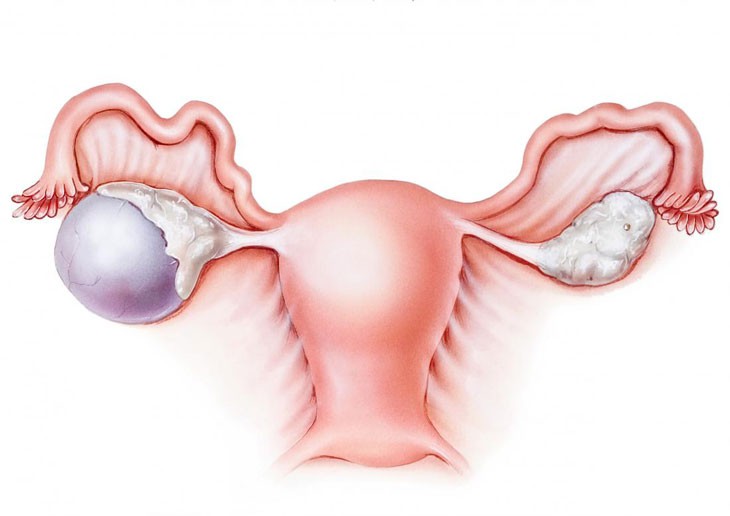Xuất tinh bên trong âm đạo có thể gây ra chuột rút cho phụ nữ? - Ảnh 6. Xuất tinh bên trong âm đạo có thể gây ra chuột rút cho phụ nữ? - Ảnh 6.