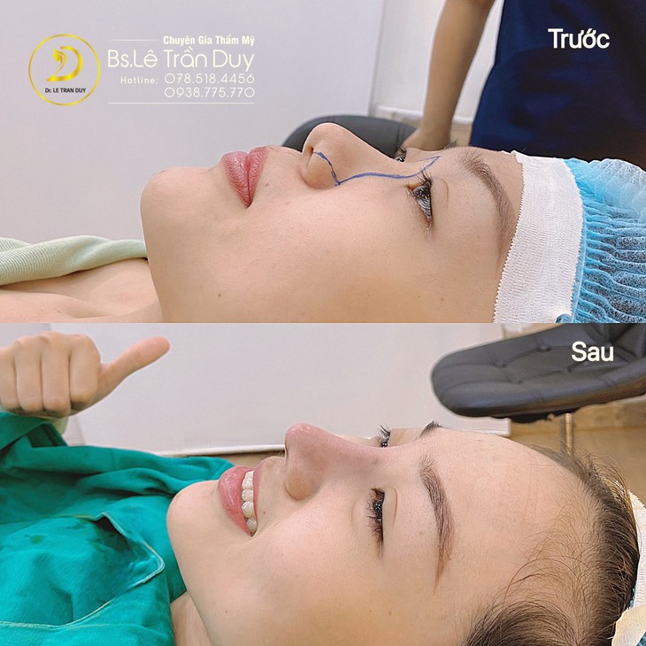 Nâng mũi sụn tự thân tuyệt đẹp ở bác sĩ tài năng - Ảnh 2.