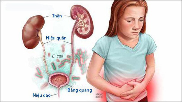 Mùa nóng: Cần làm gì để phát hiện bệnh nhiễm trùng đường tiểu ở trẻ - Ảnh 4.