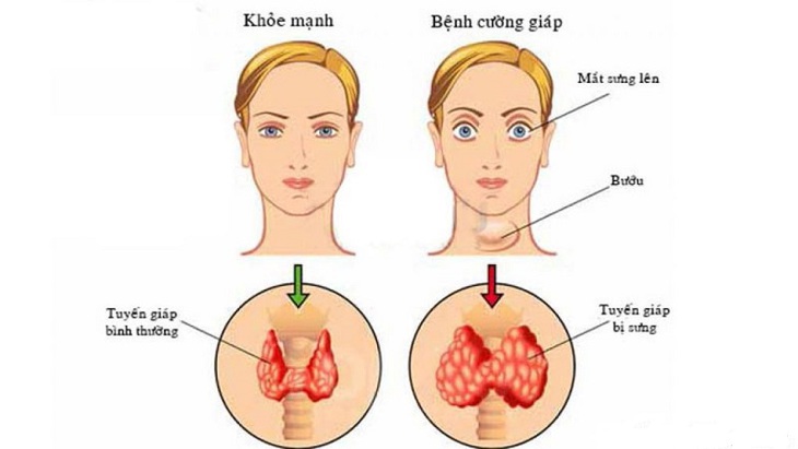 Bệnh cường giáp là gì, chữa thế nào?- Ảnh 1.