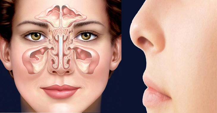 Viêm họng mạn tính có lây sang viêm xoang không? - Ảnh 4. Viêm họng mạn tính có lây sang viêm xoang không? - Ảnh 4.
