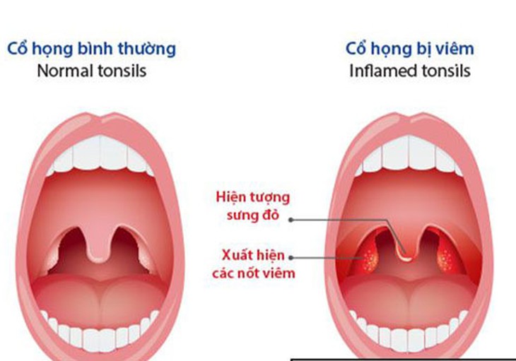 Viêm họng mạn tính có lây sang viêm xoang không? - Ảnh 2. Viêm họng mạn tính có lây sang viêm xoang không? - Ảnh 2.