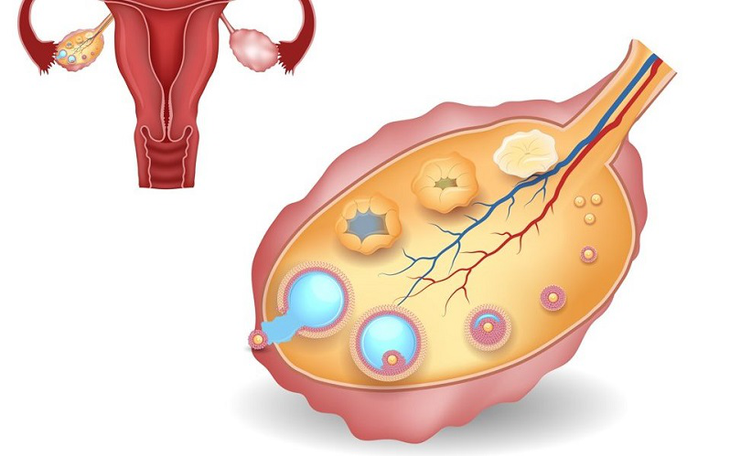 Những nguyên nhân có thể gây cơn đau do chuột rút ở phụ nữ sau 'chuyện ấy'