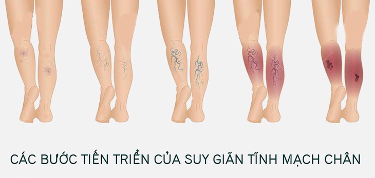 Giãn tĩnh mạch chân là hiện tượng tĩnh mạch ngoại biên bị giãn ra, nổi rõ trên bề mặt da.
