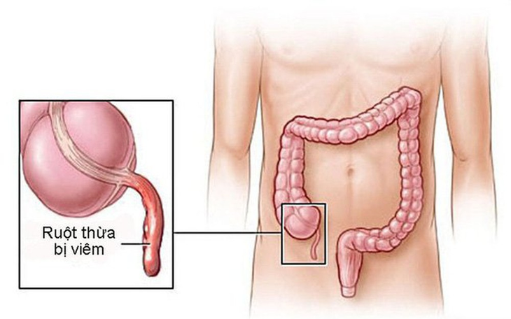 Viêm ruột thừa: Sự chủ quan và những hậu quả khôn lường