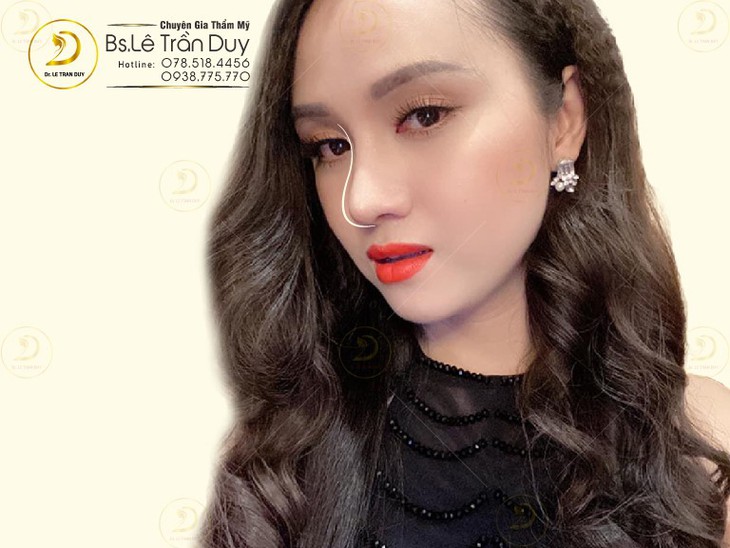 Nâng mũi bọc sụn Megaderm đẹp như ý ở bác sĩ giỏi - Ảnh 2.