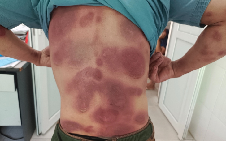 Nhiễm độc toàn thân do tự dùng thuốc điều trị viêm gan B