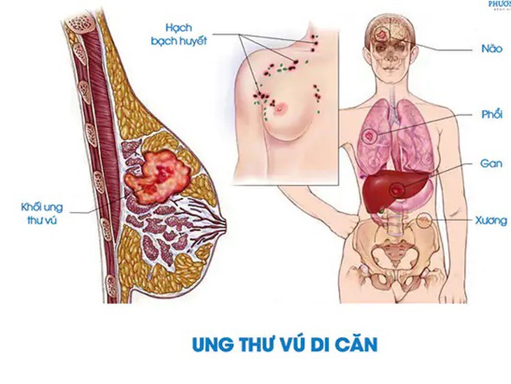 Ung thư vú di căn đến đâu và các biểu hiện như thế nào? - Ảnh 2.