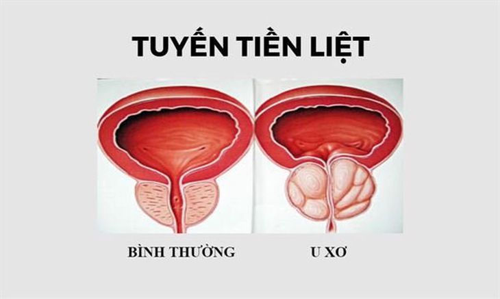 Biến chứng thường gặp và biến chứng sau mổ u xơ tiền liệt tuyến - Ảnh 1. Biến chứng thường gặp và biến chứng sau mổ u xơ tiền liệt tuyến - Ảnh 1.