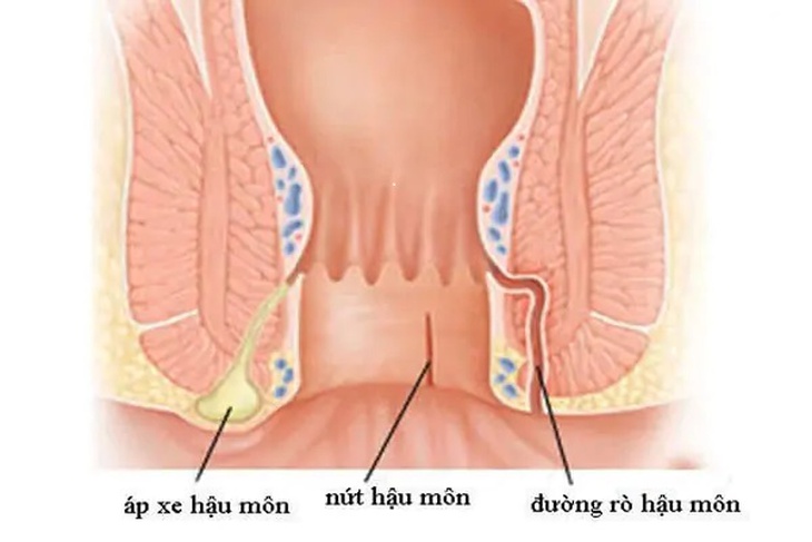 Rò trực tràng: Nguyên nhân, biểu hiện, biến chứng và điều trị - Ảnh 1. Rò trực tràng: Nguyên nhân, biểu hiện, biến chứng và điều trị - Ảnh 1.