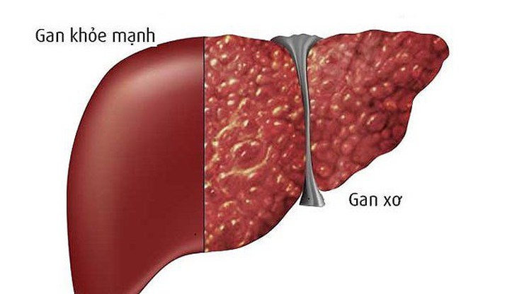 Người mắc bệnh xơ gan nên ăn gì, kiêng gì? - Ảnh 2.