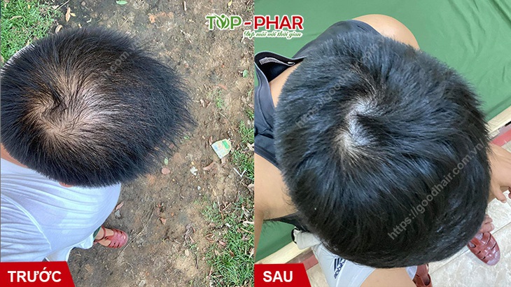 DHT Blocker là gì, có giúp giảm rụng tóc, hói đầu? - Ảnh 3.