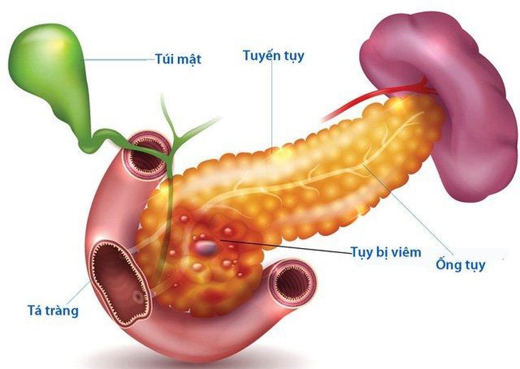 Viêm tụy cấp ở trẻ em: Nguyên nhân, triệu chứng, điều trị và những điều cần biết - Ảnh 2.