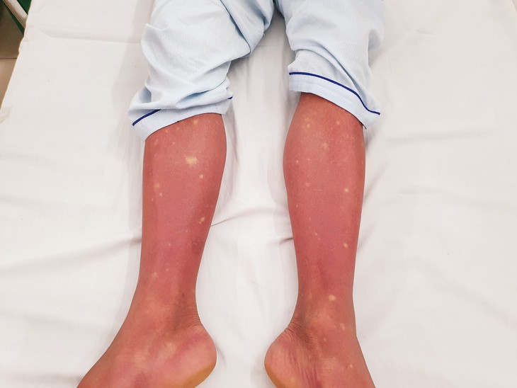 Cảnh giác bùng phát dịch sốt xuất huyết Dengue ở miền Bắc - Ảnh 3.