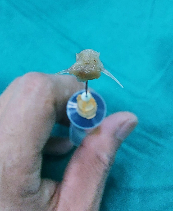 Gắp mảnh xương cá sắc nhọn trong thanh quản của bệnh nhi 2 tuổi - Ảnh 1. Gắp mảnh xương cá sắc nhọn trong thanh quản của bệnh nhi 2 tuổi - Ảnh 1.