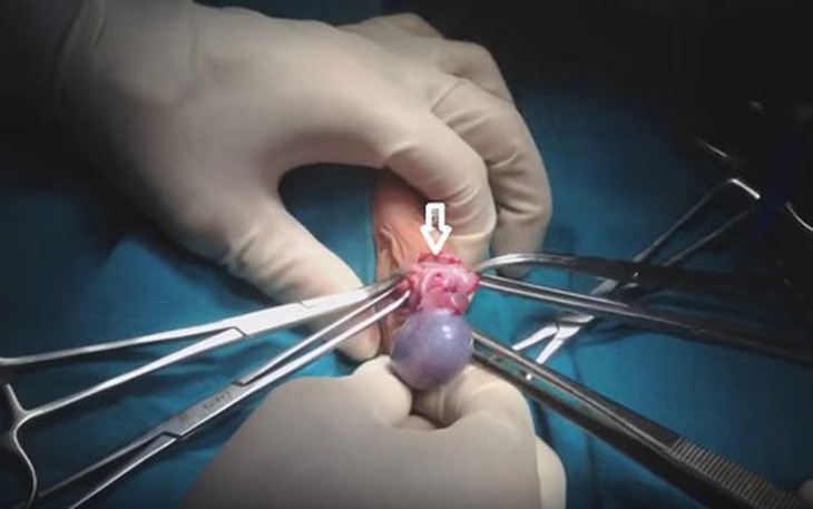 Chuyên gia khuyến cáo không nên chủ quan trước bệnh xoắn tinh hoàn ở trẻ - Ảnh 1. Chuyên gia khuyến cáo không nên chủ quan trước bệnh xoắn tinh hoàn ở trẻ - Ảnh 1.